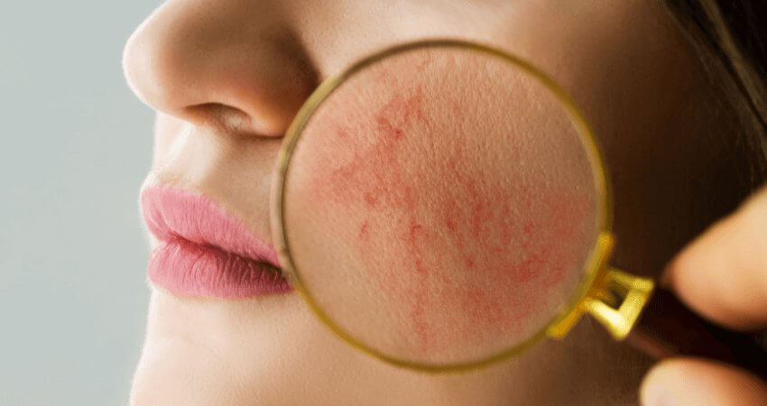 UNDERSTANDING ROSACEA - JUSTBLiSS Soap