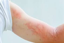 HOW TO DO A SIMPLE ALLERGY PATCH TEST - JUSTBLiSS Naturals